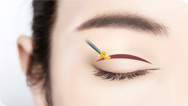 눈밑지방재배치 전후